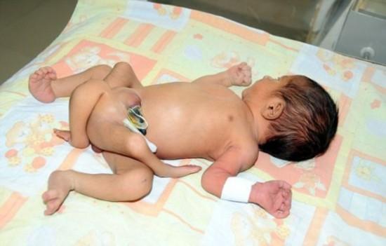 巴基斯坦医生拯救6腿新生儿 出现概率仅为一百万分之一