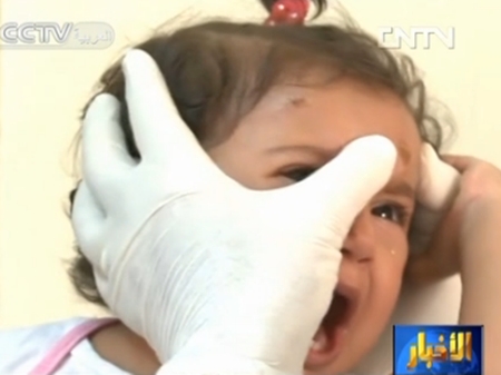 داء الليشمانيات الجلدي ينتشر بين اللاجئين السوريين في لبنان