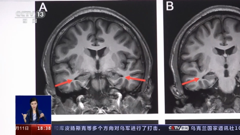 [共同关注]一问到底·阿尔茨海默病为何出现年轻化趋势？19岁男孩确诊 短期记忆丧失明显