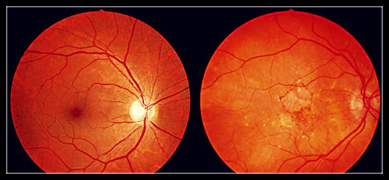 线,红外线光波以及营养不良,老年人衰老性黄斑都可能导致眼底黄斑病变